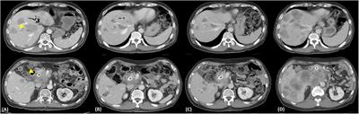 Case report: Acquired neurotrophic tyrosine receptor kinase inhibitor resistance in a patient with pancreatic neuroendocrine carcinoma receiving entrectinib